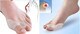 CMS Medical Silica Gel Dual Action Toe Spacer Bunion Guard Combo
